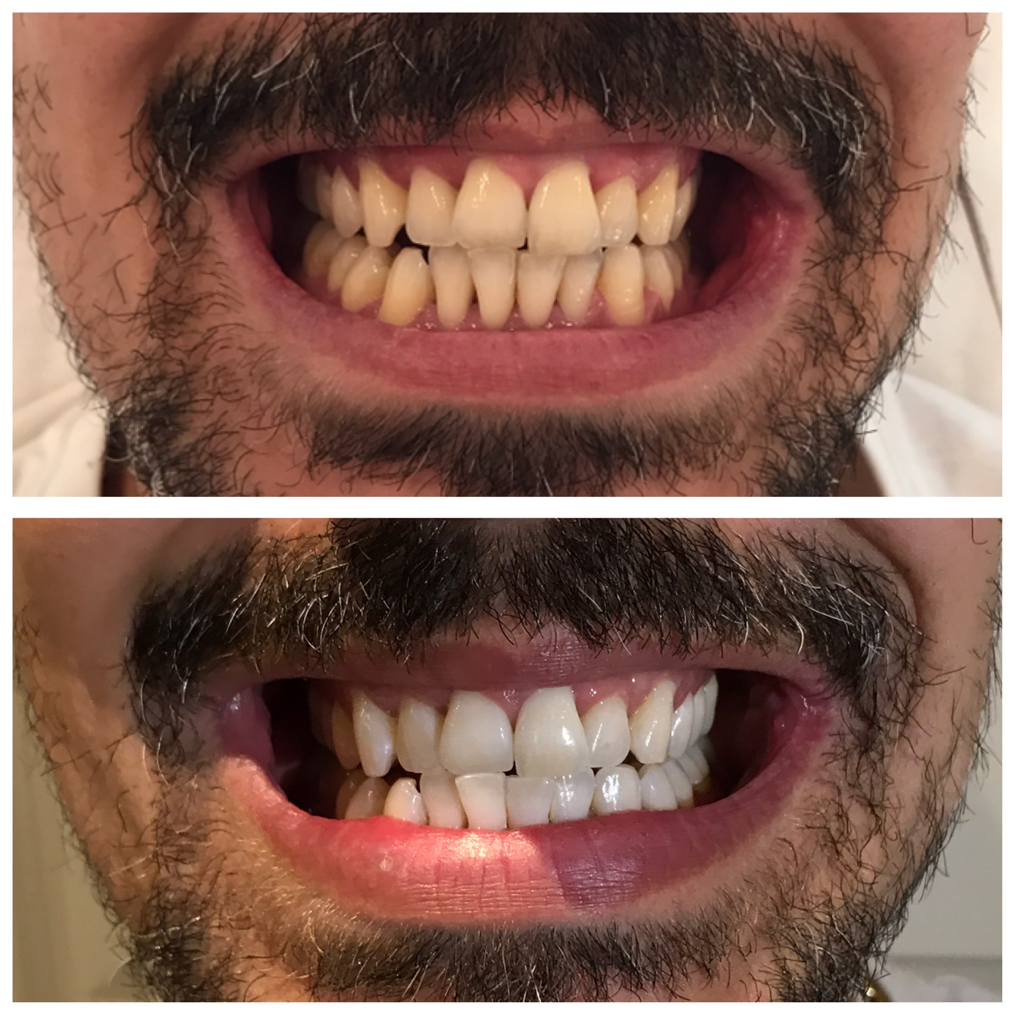Tandblekning före och efter